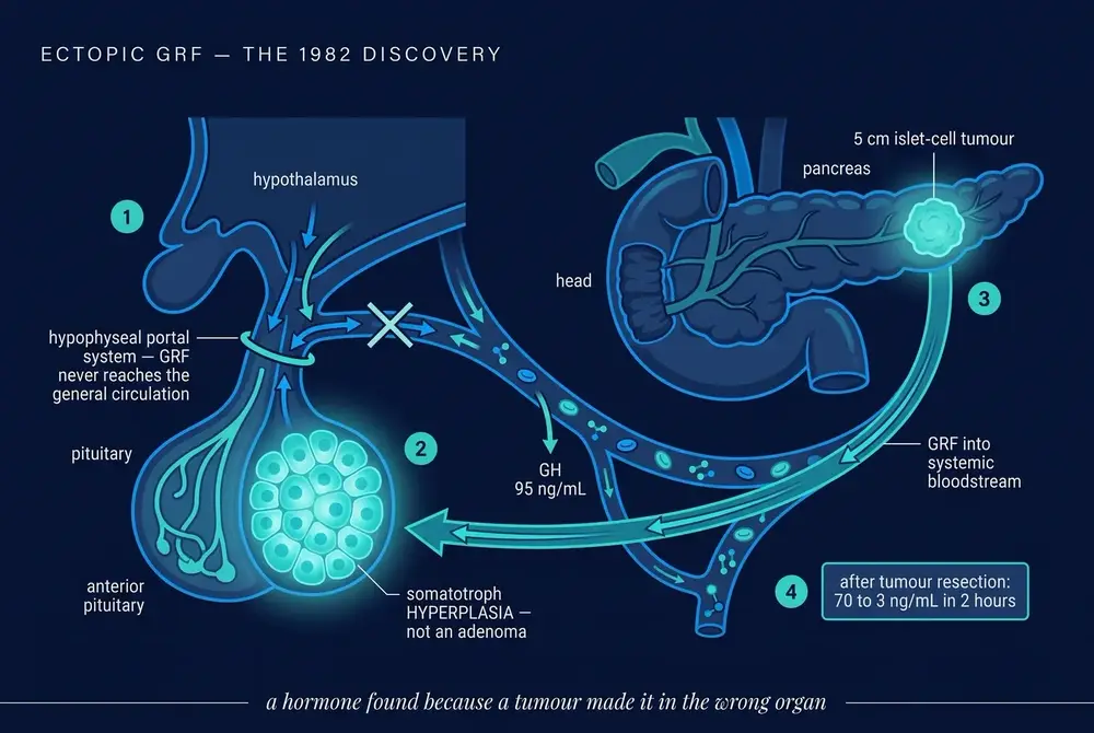 Anatomical diagram of ectopic GRF secretion from a pancreatic islet tumour driving pituitary somatotroph hyperplasia